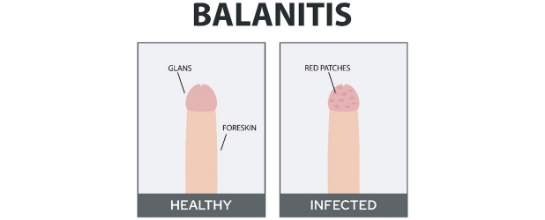 Balanitis