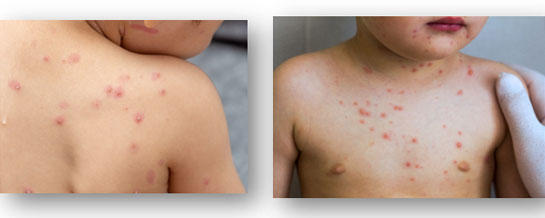 How to Care for Your Child with a Chicken Pox