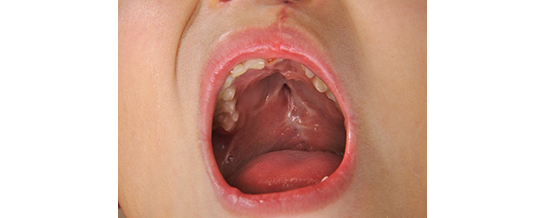 Cleft Palate