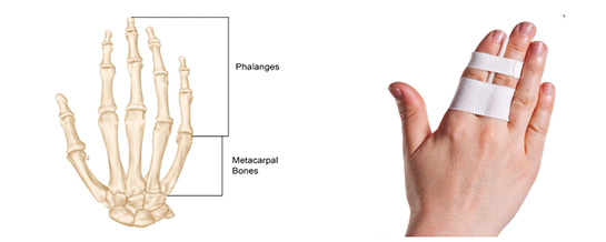 X Ray Broken Finger