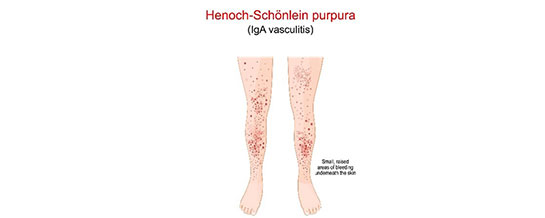 Henoch-Schoenlein Purpura