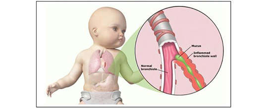 bronchiolitis