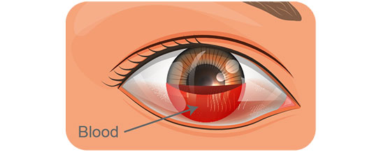 Hyphema (Bleeding in the eye)