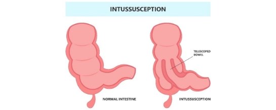 How to Care for Your Child with Intussusception