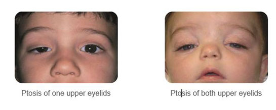 Ptosis (Drooping Eye Lid)