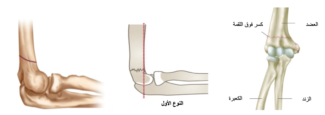 fracture image
