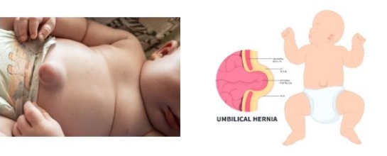 Umbilical Hernia