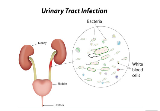 Urinary Tract Infection (UTI): Symptoms, Diagnosis & Treatment